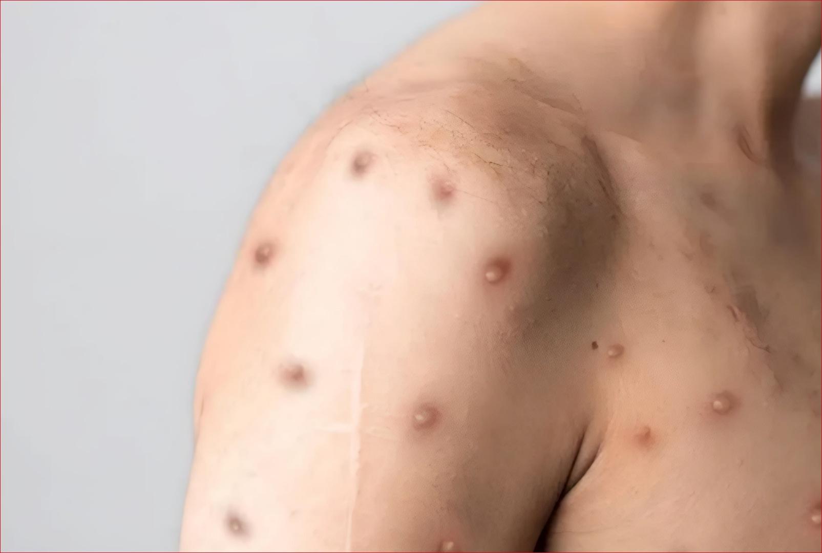foto de Brasil contabiliza 1,5 mil casos de mpox em 2024