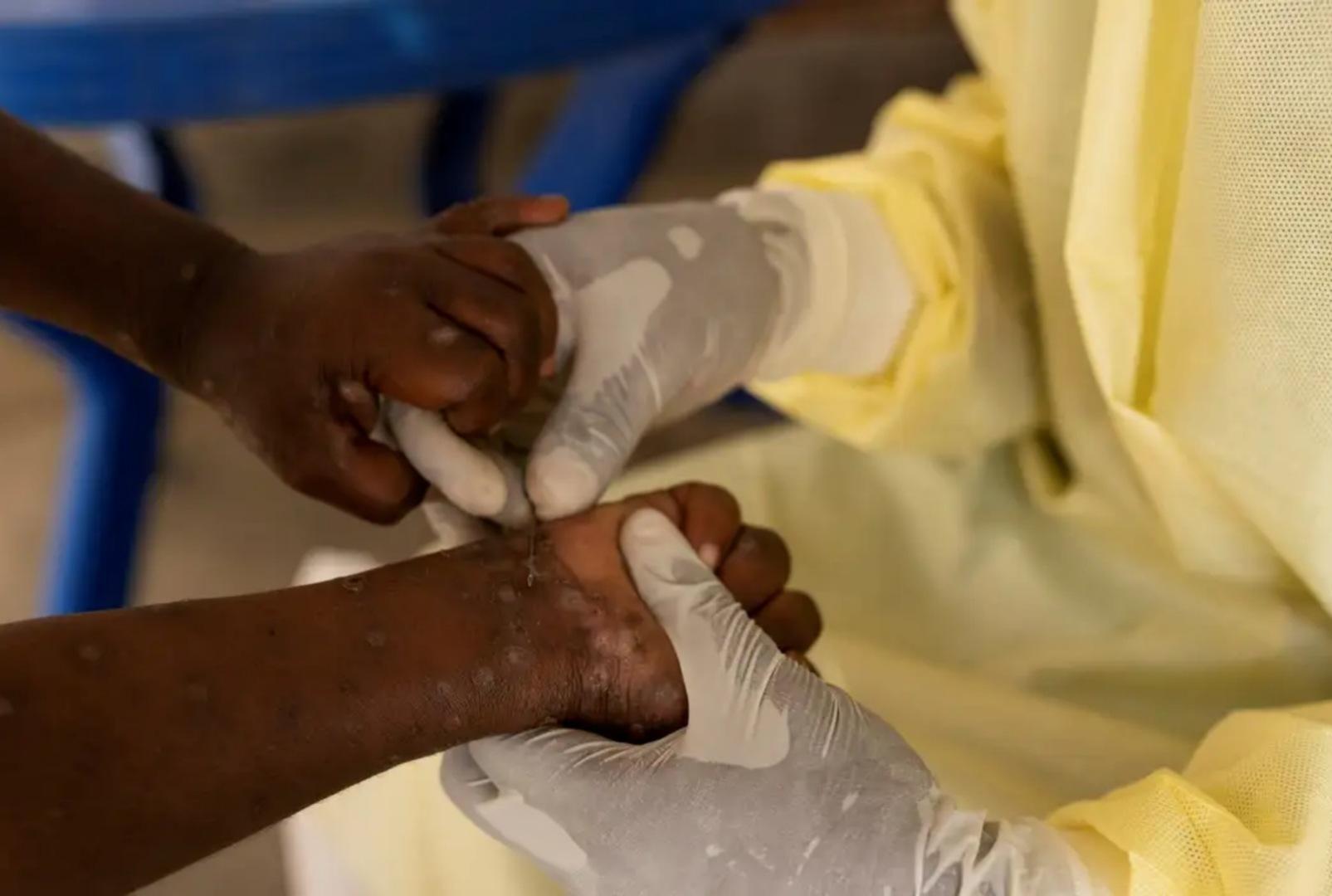 foto de Saúde confirma primeiro caso de nova cepa de mpox no Brasil
