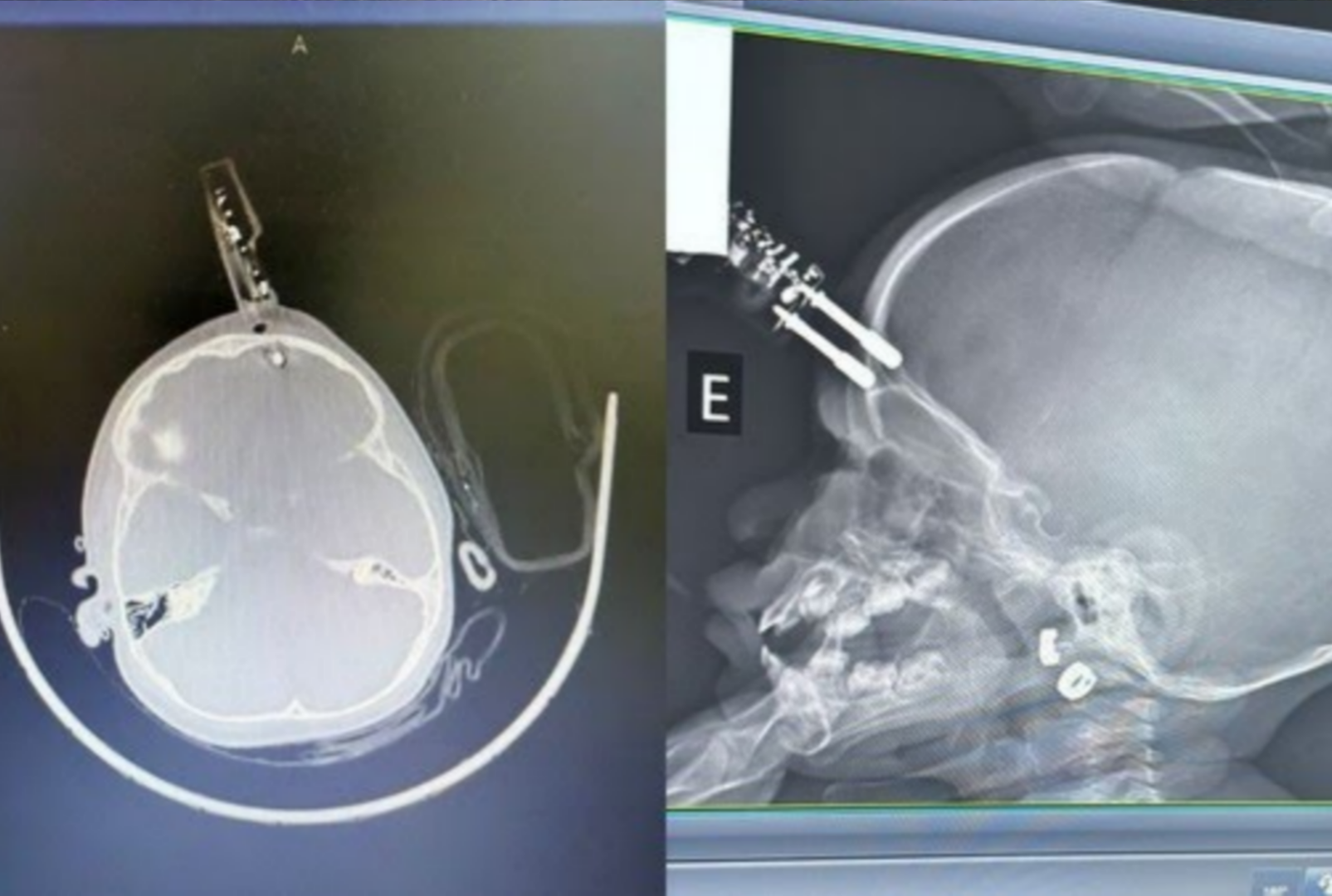 foto de Menina de 1 ano que teve carregador cravado na testa recebe alta após cirurgia