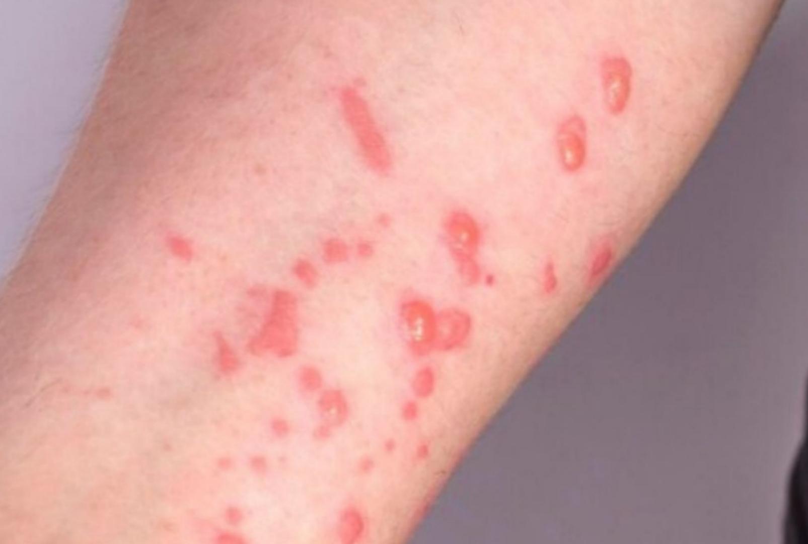 foto de Autoridades confirmam 48 casos de mpox em 2026; veja como se proteger