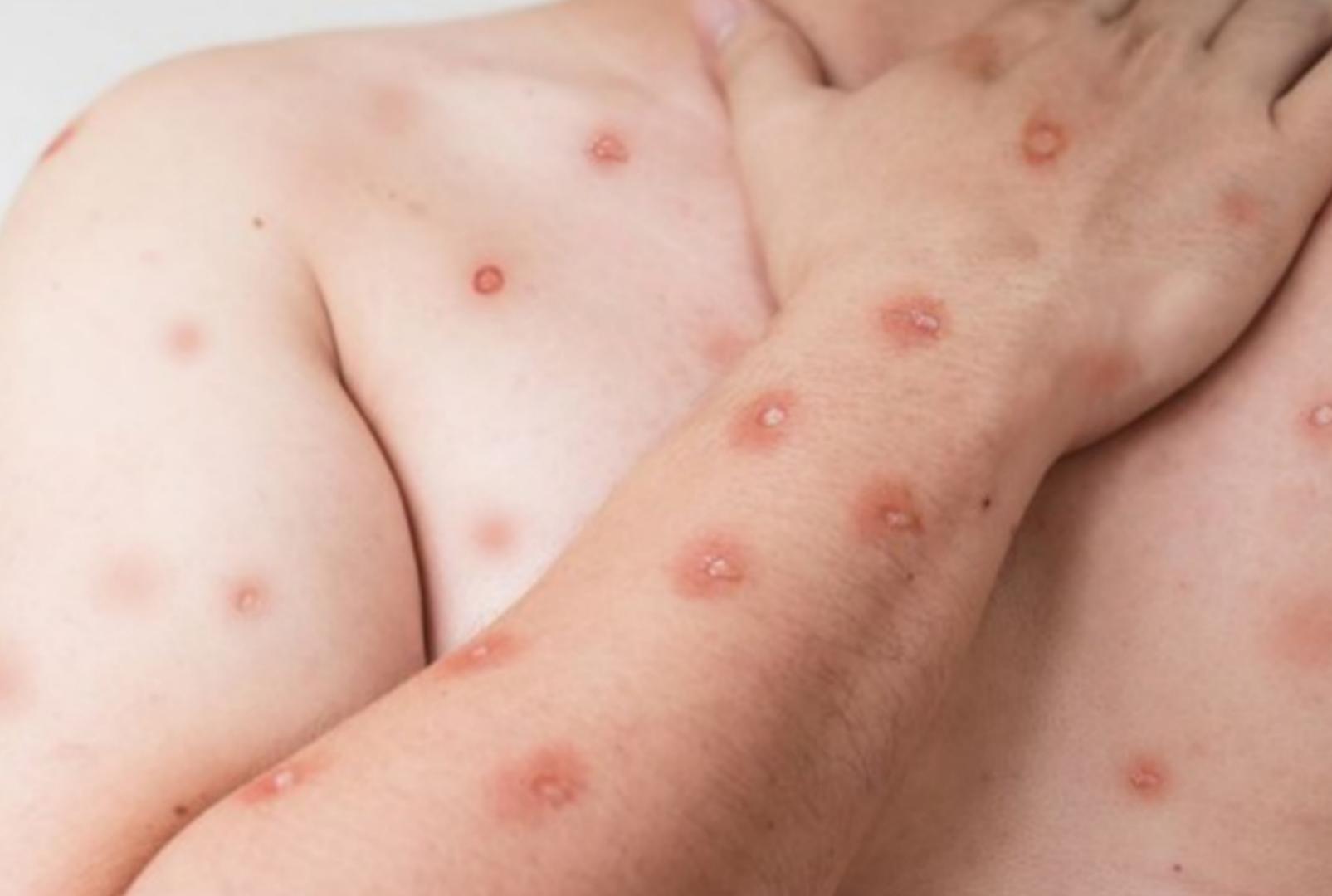 foto de Novo boletim mostra 90 casos de mpox no Brasil e inclui o Paraná