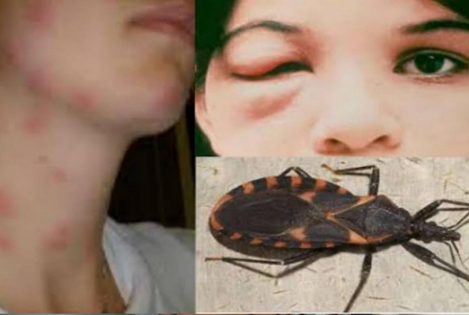 foto de Doença de Chagas cresce no Paraná: Sesa reforça alerta e cuidados com o bicho-barbeiro; saiba os sintomas