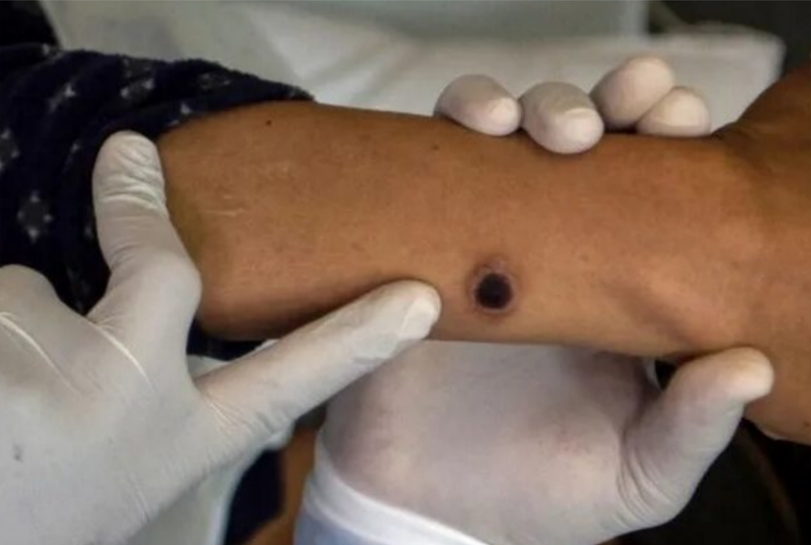 Mpox avança no Brasil com 136 casos; Paraná tem dois registros da doença