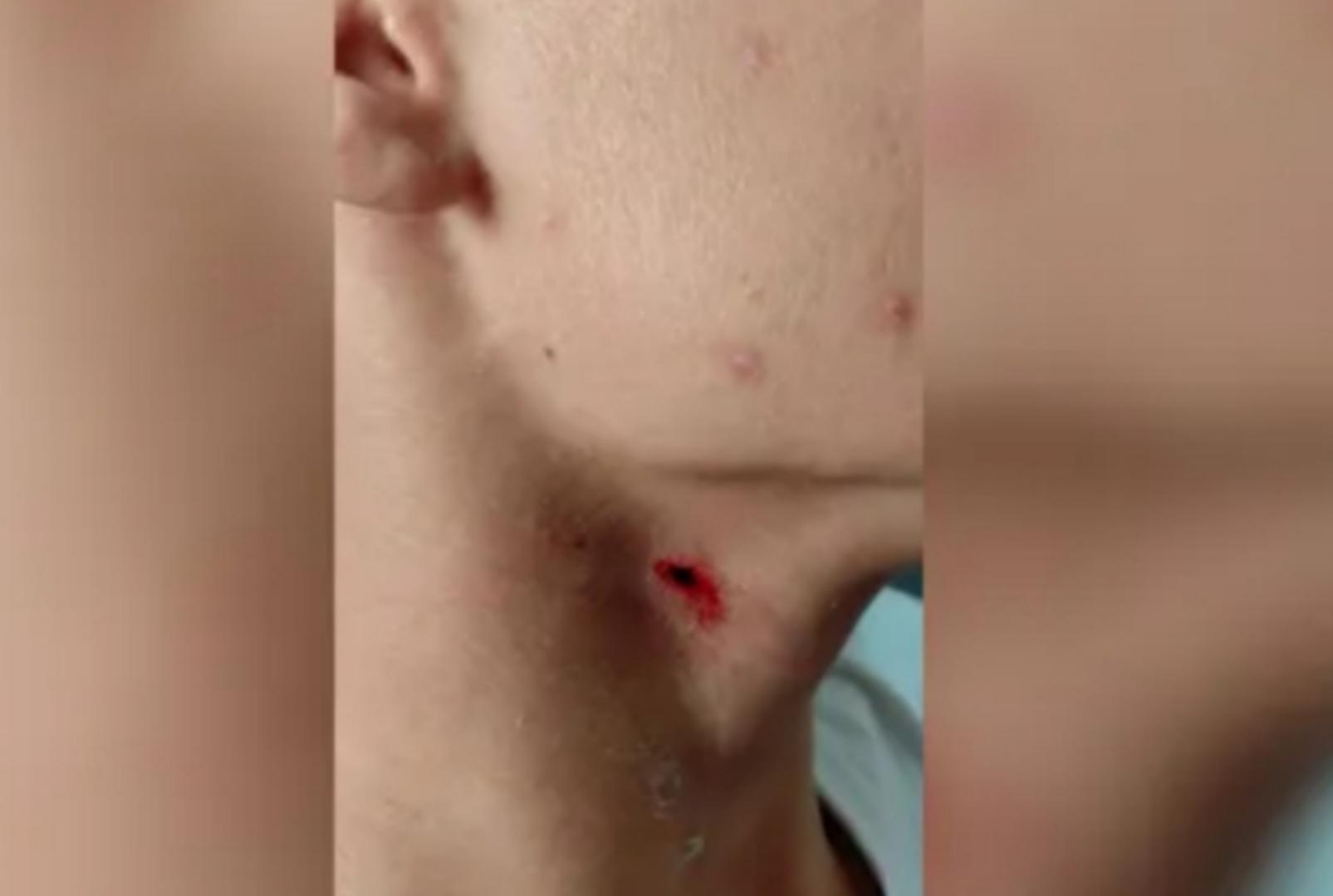 foto de Estudante de 13 anos tem pescoço perfurado com caneta dentro de sala de aula em colégio cívico-militar no Paraná