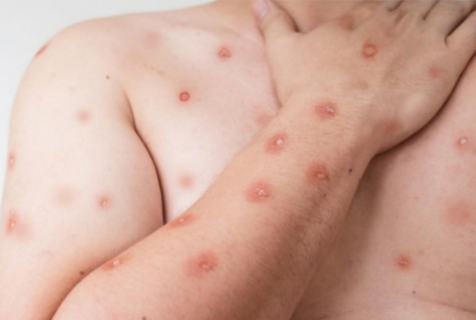 foto de Vacina contra Mpox chega ao SUS; veja quem pode tomar no Brasil