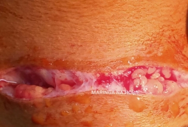 foto de Adolescente de 14 anos tem pescoço cortado por linha com cerol em Maringá 