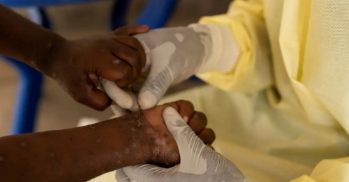 Saúde confirma primeiro caso de nova cepa de mpox no Brasil