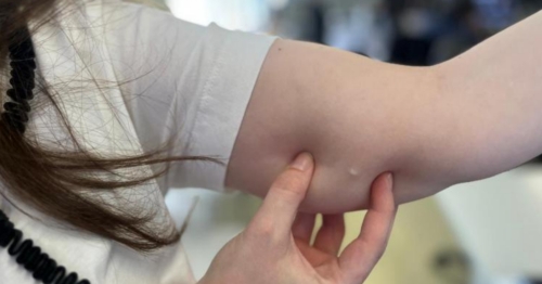 Aumento na procura por implantes contraceptivos no SUS no Paraná