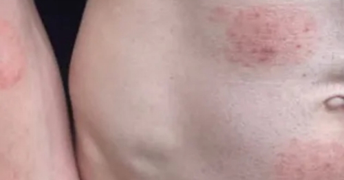 Novo fungo altamente contagioso se espalha por contato íntimo e acende alerta global: entenda o risco