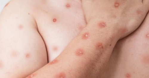 Novo boletim mostra 90 casos de mpox no Brasil e inclui o Paraná