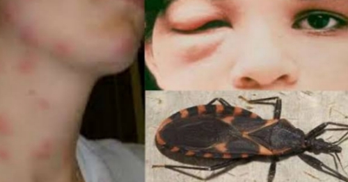 Doença de Chagas cresce no Paraná: Sesa reforça alerta e cuidados com o bicho-barbeiro; saiba os sintomas