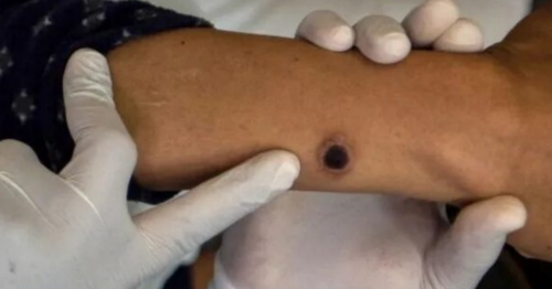 Mpox avança no Brasil com 136 casos; Paraná tem dois registros da doença