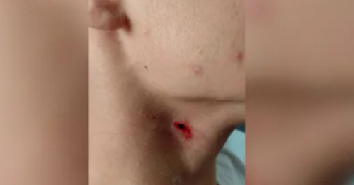 Estudante de 13 anos tem pescoço perfurado com caneta dentro de sala de aula em colégio cívico-militar no Paraná