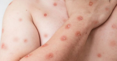 Vacina contra Mpox chega ao SUS; veja quem pode tomar no Brasil